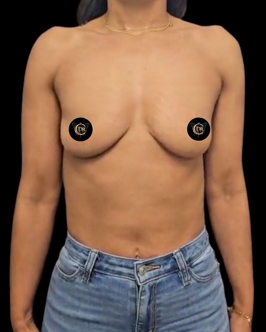 Breast Augmentation Before & After