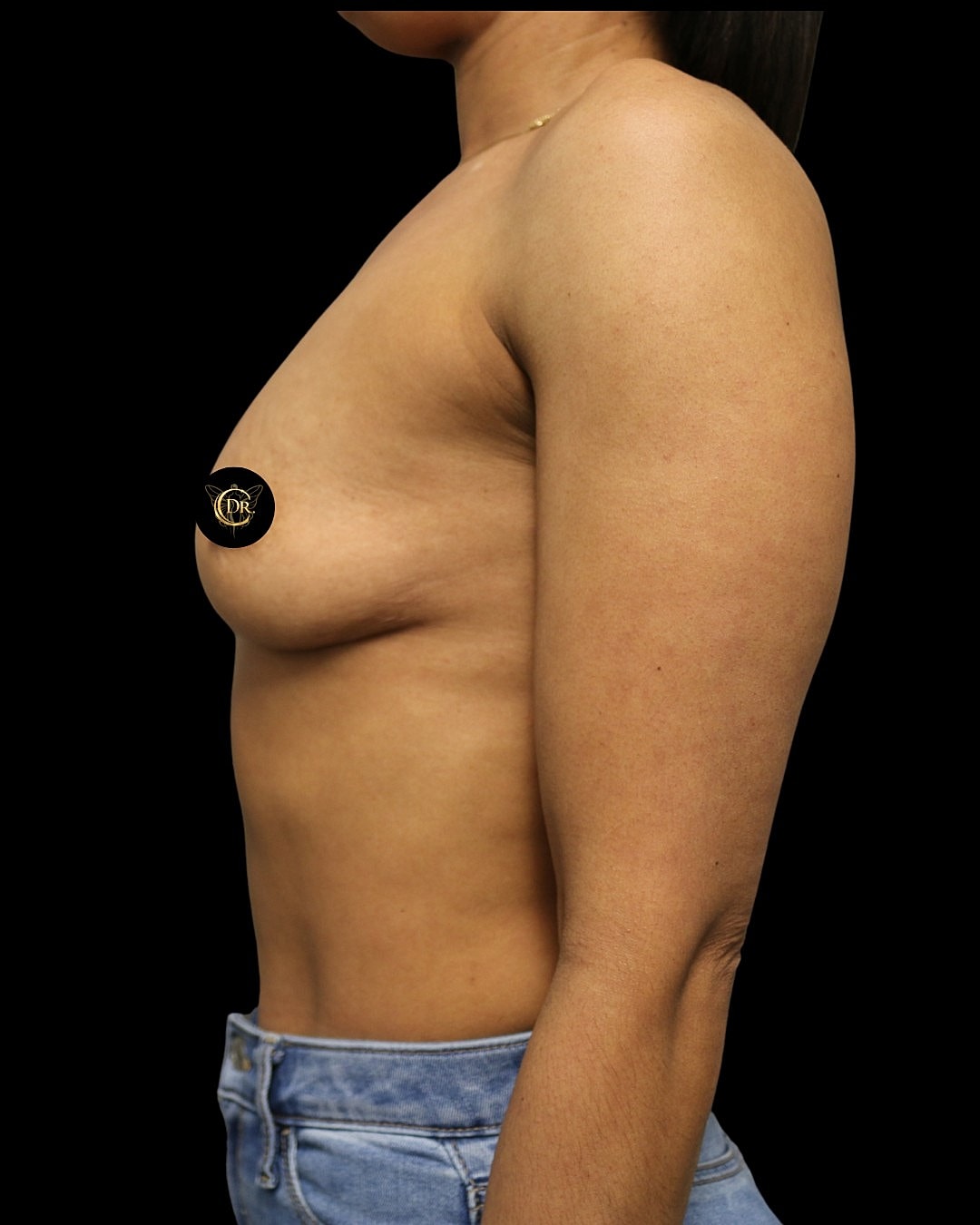 Breast Augmentation Before & After