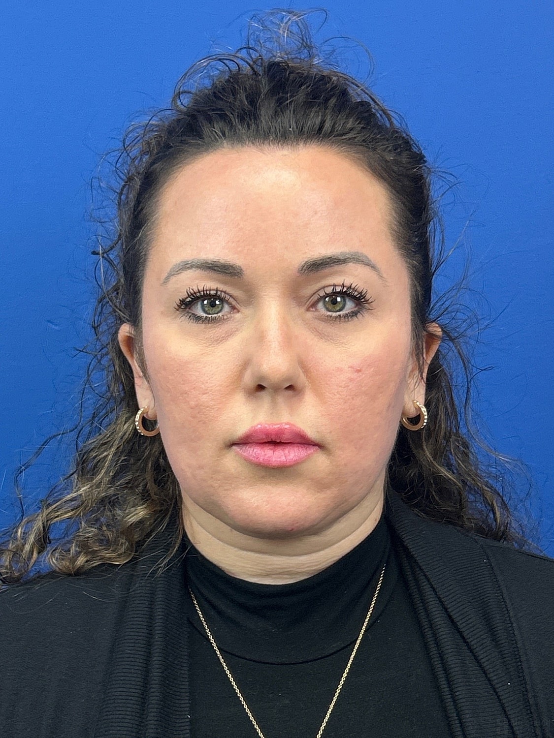 Upper Blepharoplasty Before & After