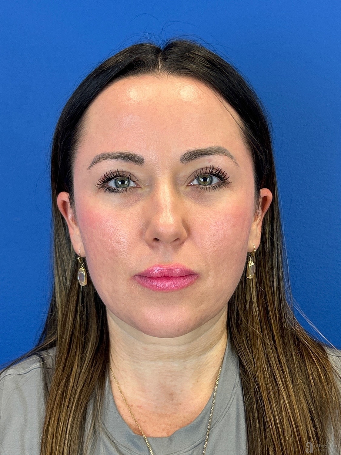 Upper Blepharoplasty Before & After