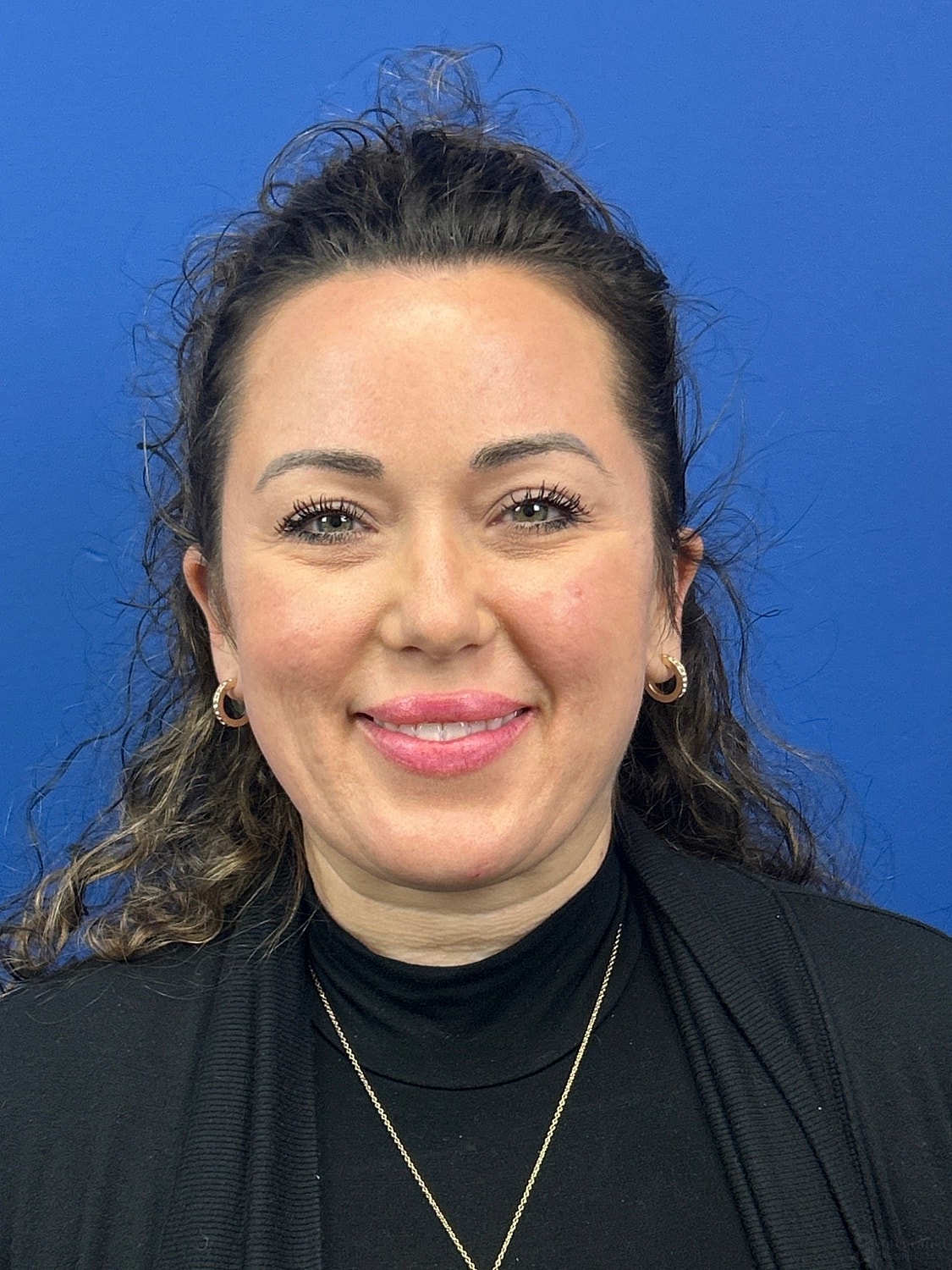 Upper Blepharoplasty Before & After