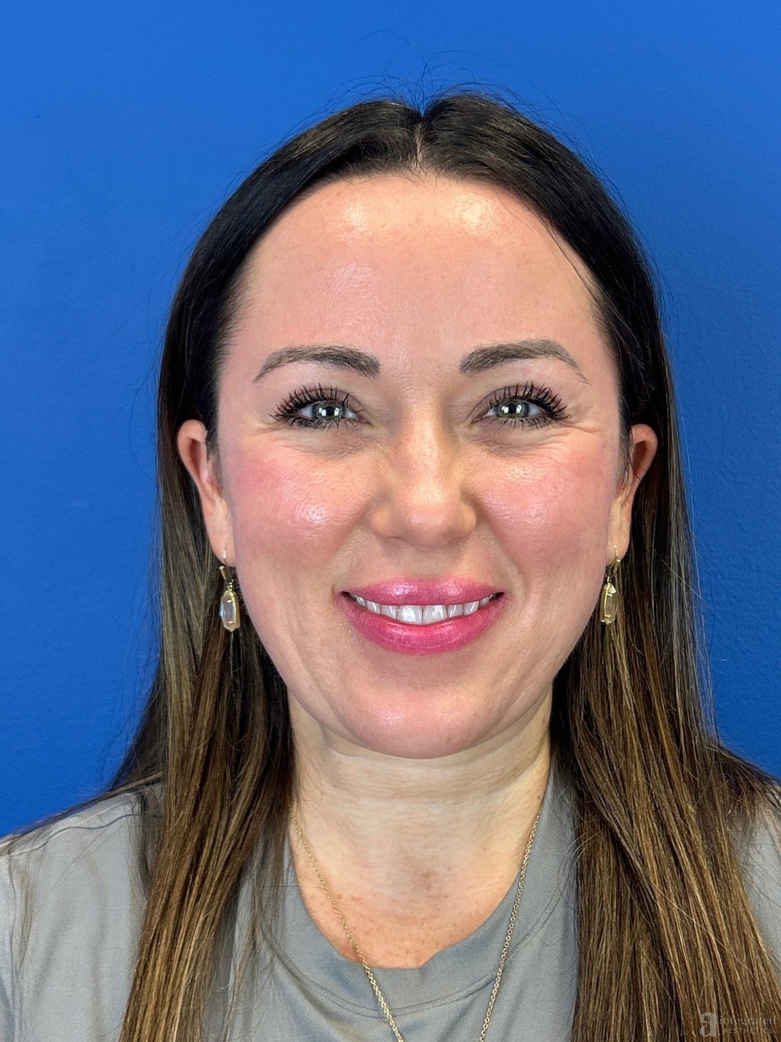 Upper Blepharoplasty Before & After