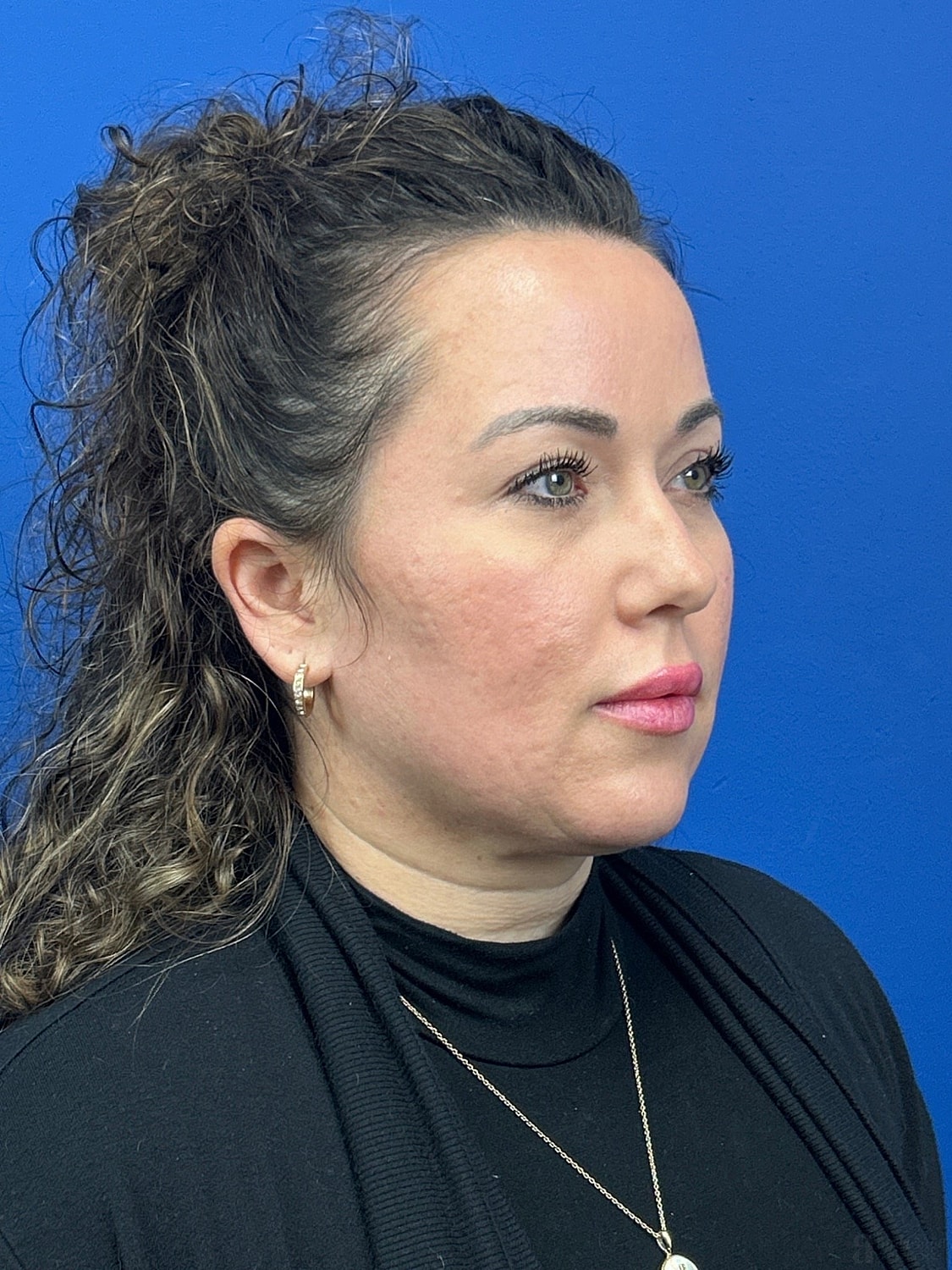 Upper Blepharoplasty Before & After