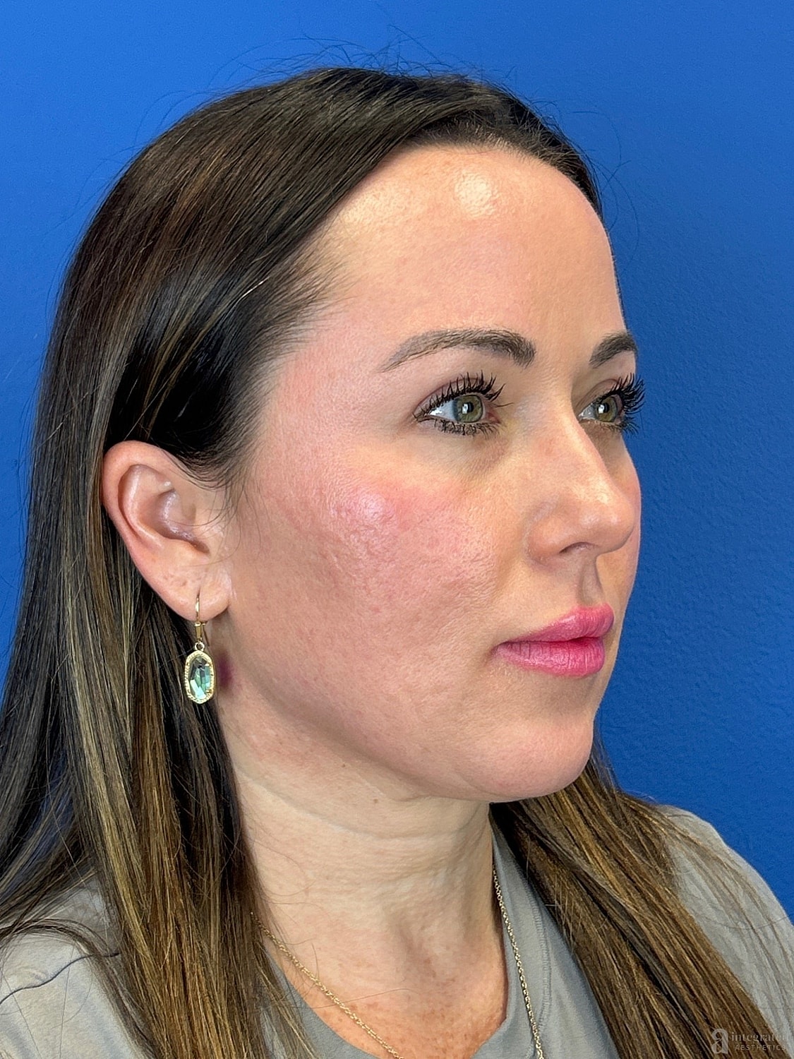 Upper Blepharoplasty Before & After