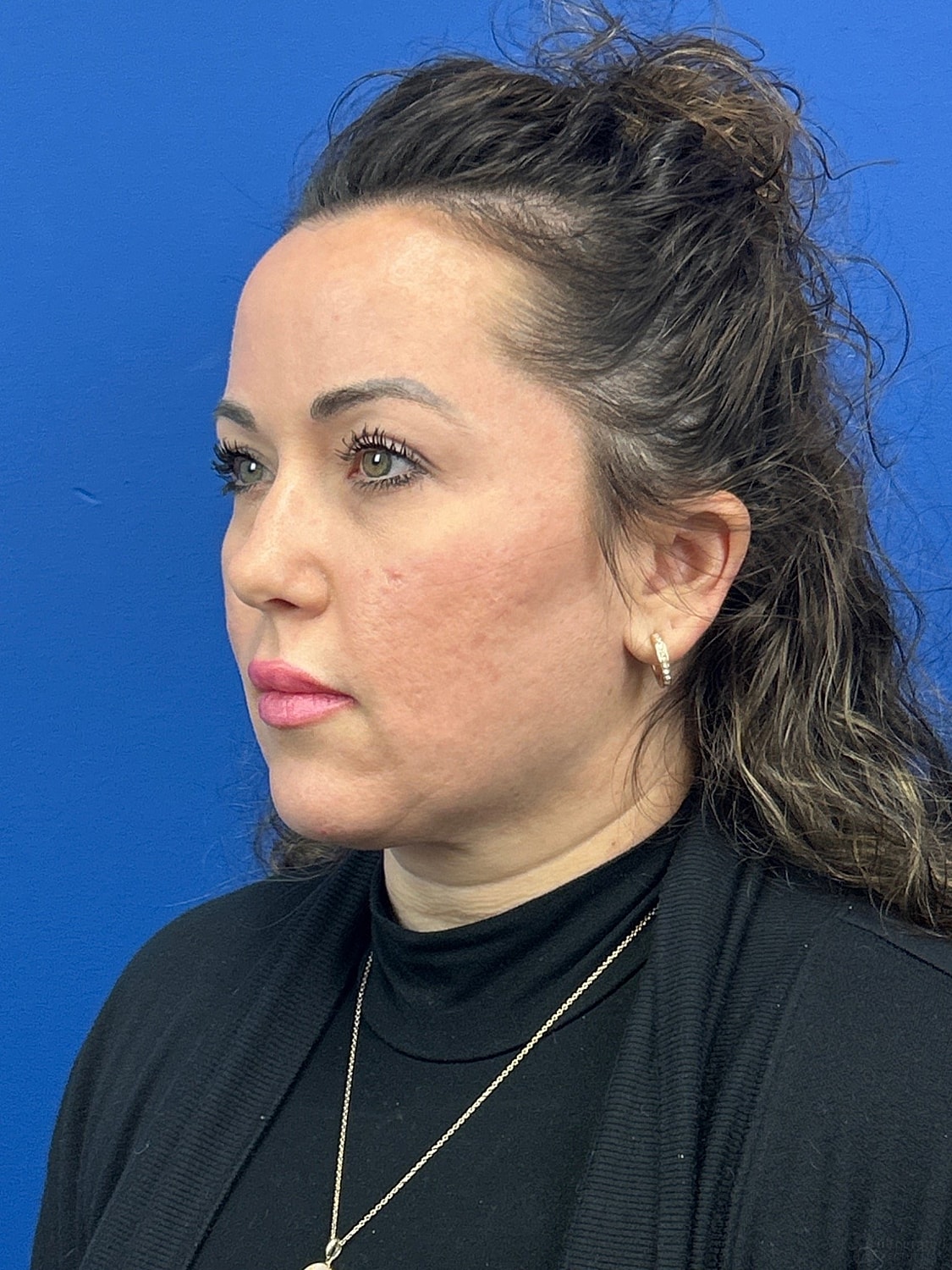 Upper Blepharoplasty Before & After