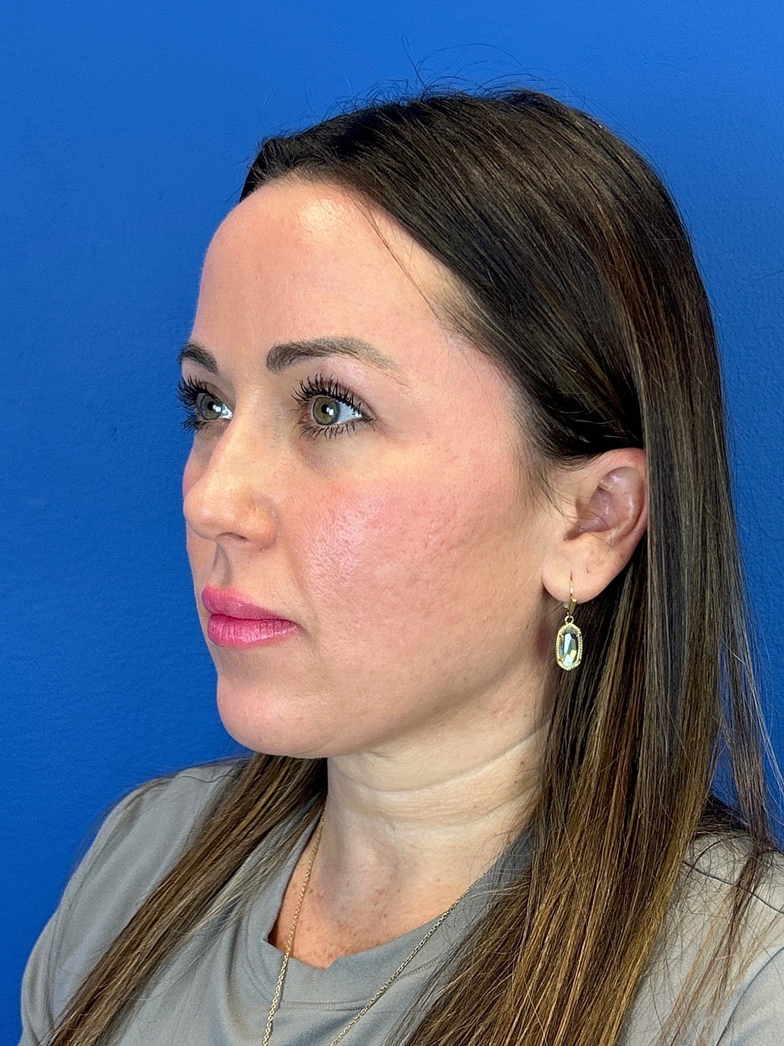 Upper Blepharoplasty Before & After