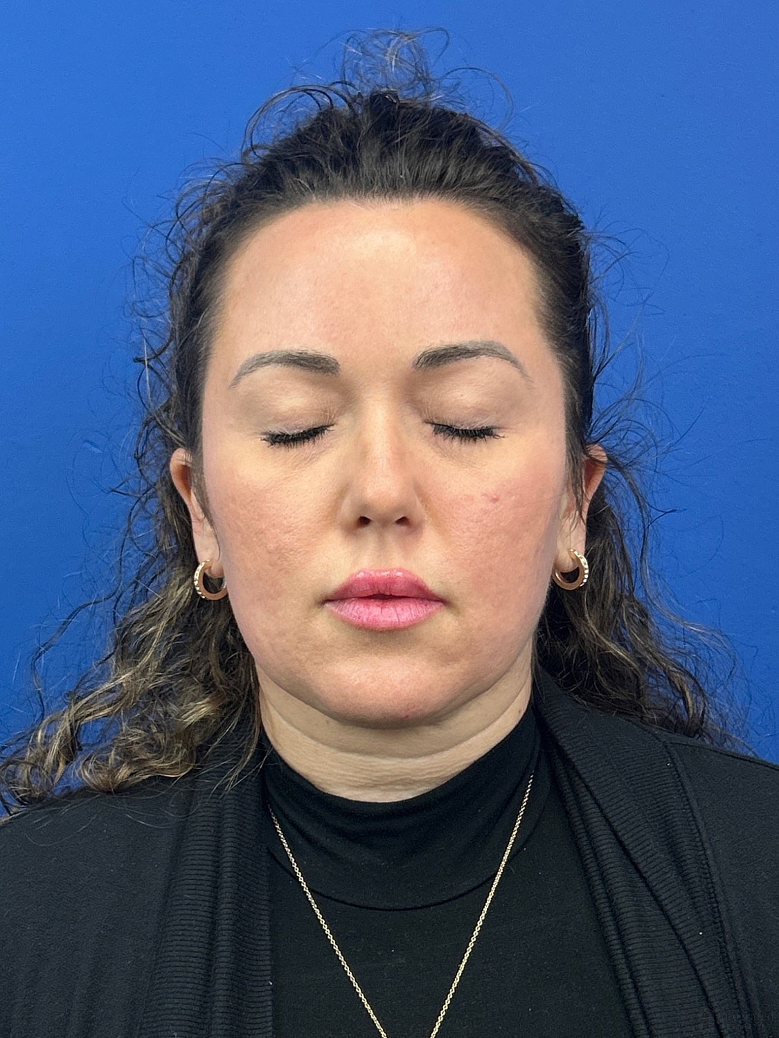 Upper Blepharoplasty Before & After