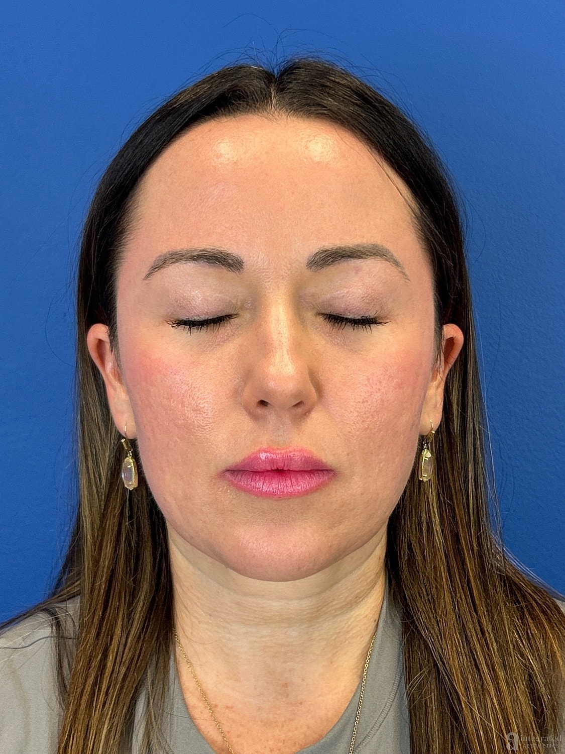 Upper Blepharoplasty Before & After