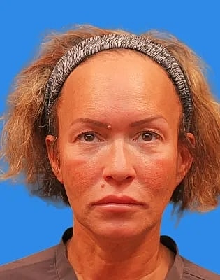 Upper Blepharoplasty Before & After