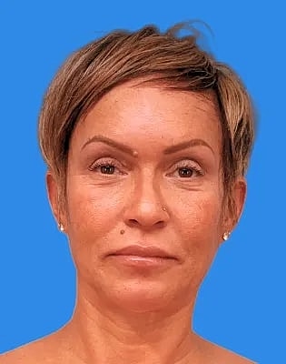 Upper Blepharoplasty Before & After