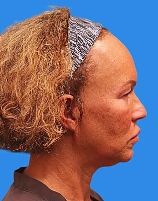 Upper Blepharoplasty Before & After