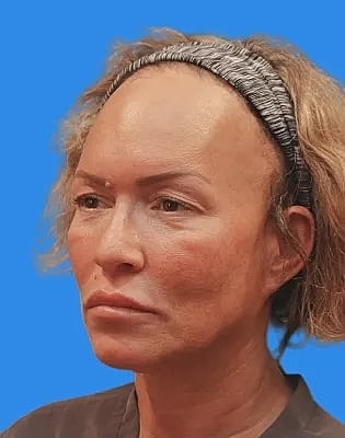 Upper Blepharoplasty Before & After