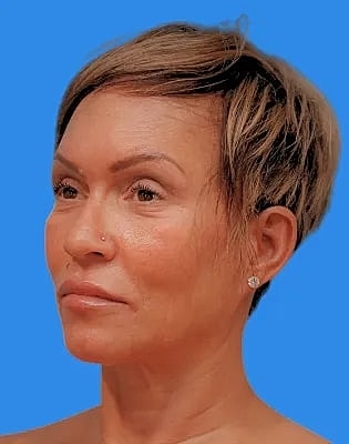 Upper Blepharoplasty Before & After