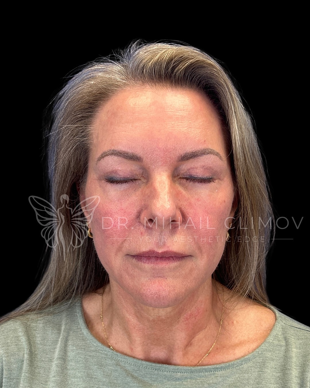 Upper eyelid blepharoplasty after photo, front eyes-closed view, showing smooth taut upper lid skin and clean incision line following eyelid lift in Houston.