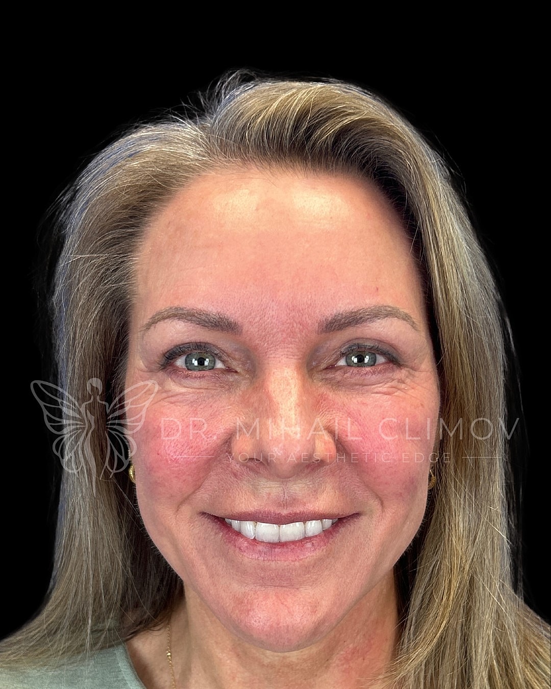 Upper blepharoplasty after photo, front smiling view, showing visible lid platform and vibrant expression following cosmetic upper lid surgery in Houston, Texas.