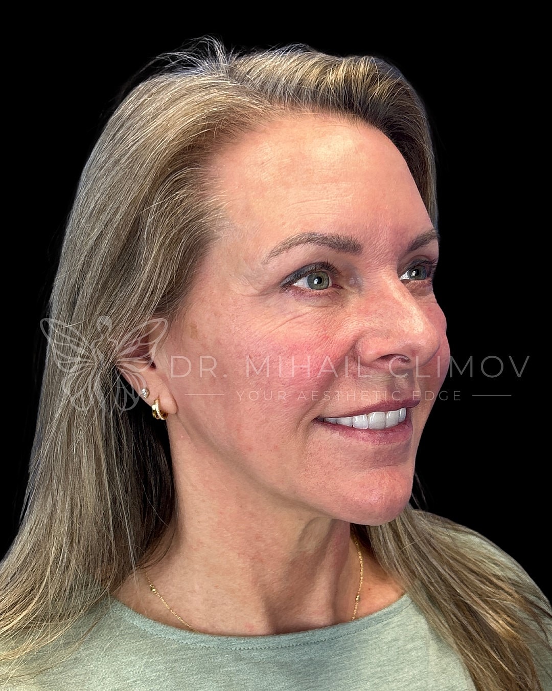Upper eyelid blepharoplasty after photo, left oblique view, showing eliminated hooding and natural youthful eye shape following cosmetic eyelid lift in Houston, Texas