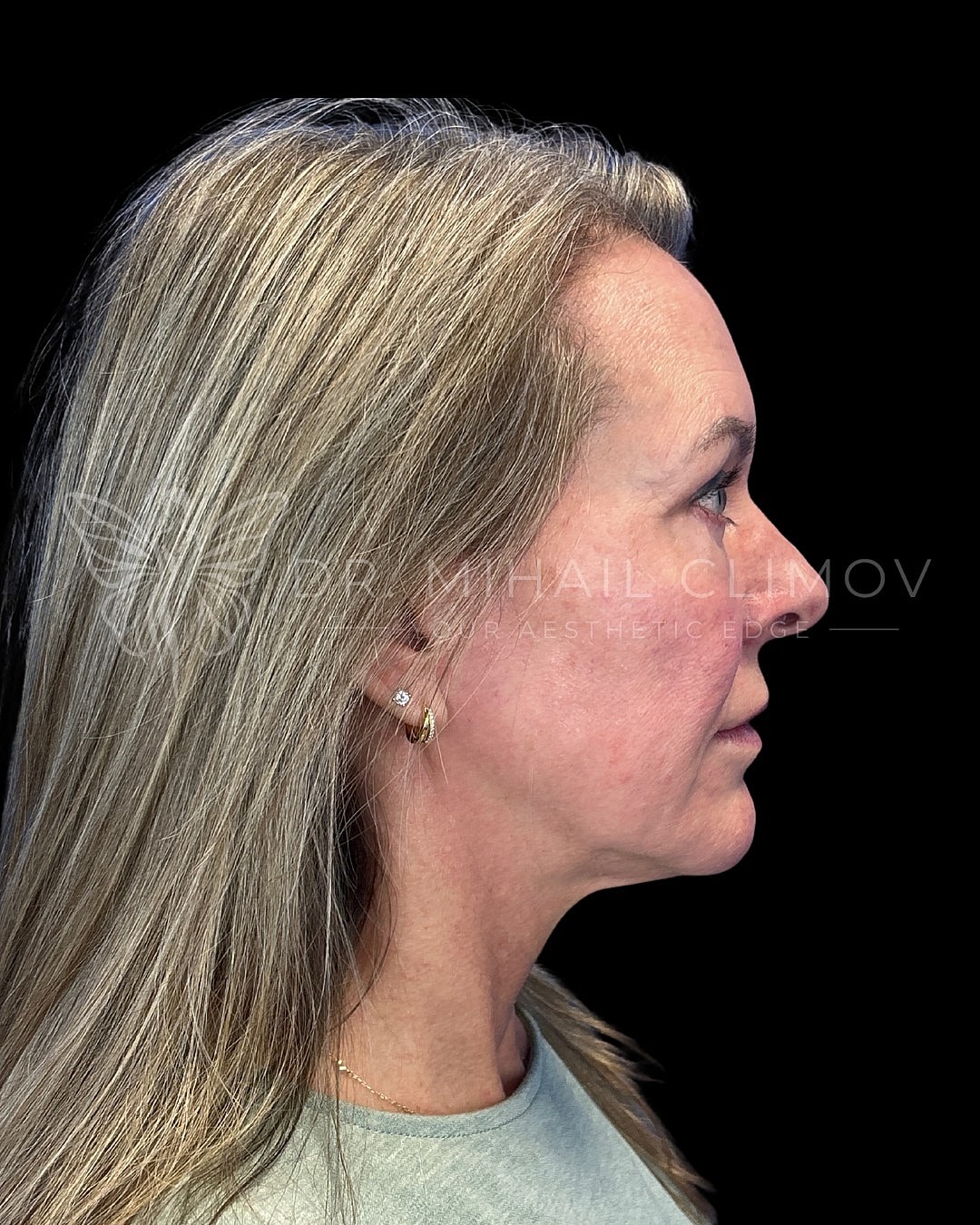 Upper blepharoplasty after photo, left side view, showing lifted upper lid contour and lighter brow profile following upper lid surgery in Houston, TX.
