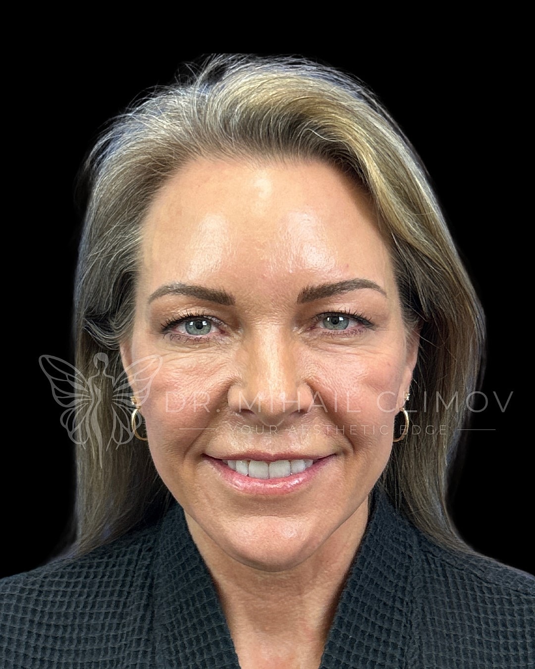 Upper blepharoplasty before photo, front smiling view, showing excess upper eyelid folds and crowded lid crease prior to cosmetic upper lid surgery in Houston, Texas.
