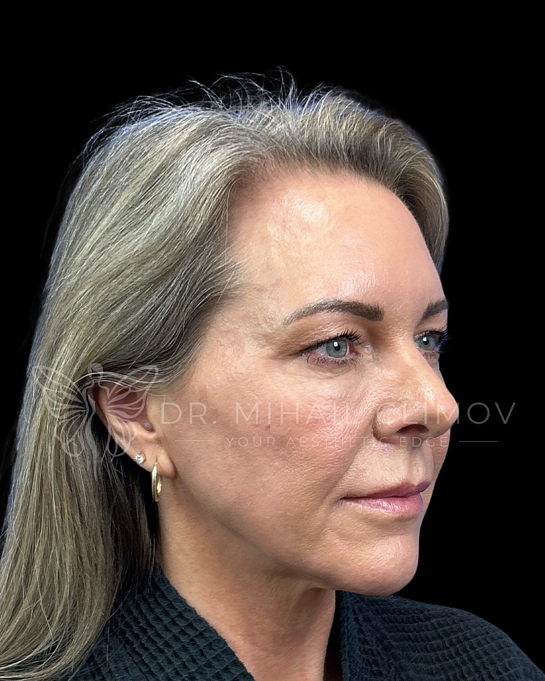 Upper eyelid blepharoplasty before photo, left view, showing lateral lid hooding and diminished eye opening prior to cosmetic eyelid lift in Houston, Texas.