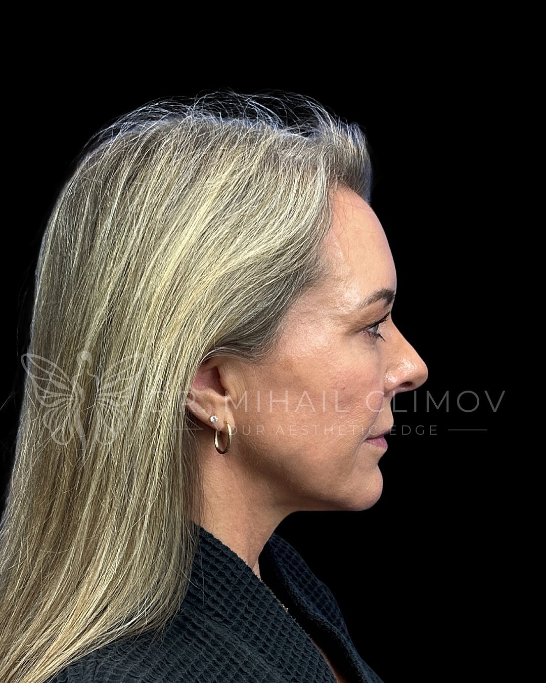 Upper blepharoplasty before photo, left side view, showing overhanging upper eyelid skin and weighted brow appearance prior to upper lid surgery in Houston, TX.