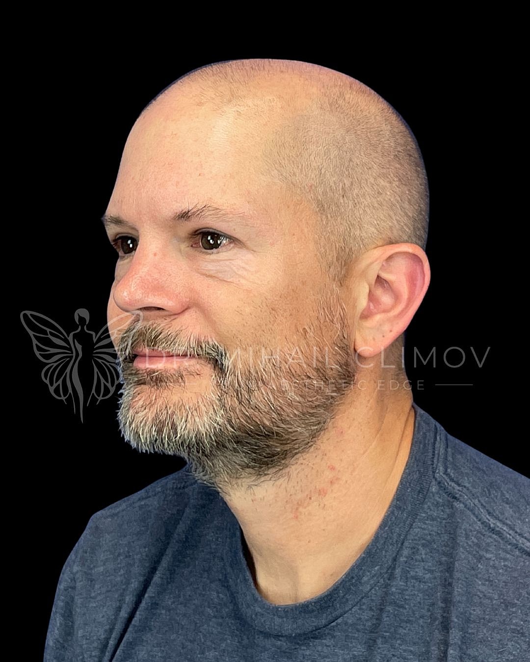 Male upper blepharoplasty after photo, right oblique view, showing open eyes and eliminated hooding following upper eyelid surgery in Houston, TX.