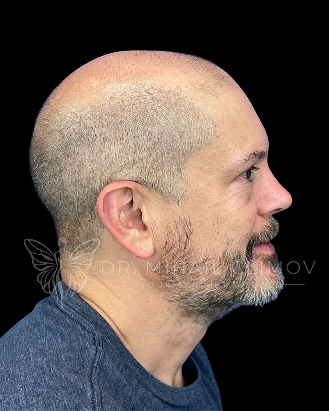 Male upper blepharoplasty after photo, left side view, showing smooth upper lid profile and restored definition following upper eyelid surgery in Houston, Texas.