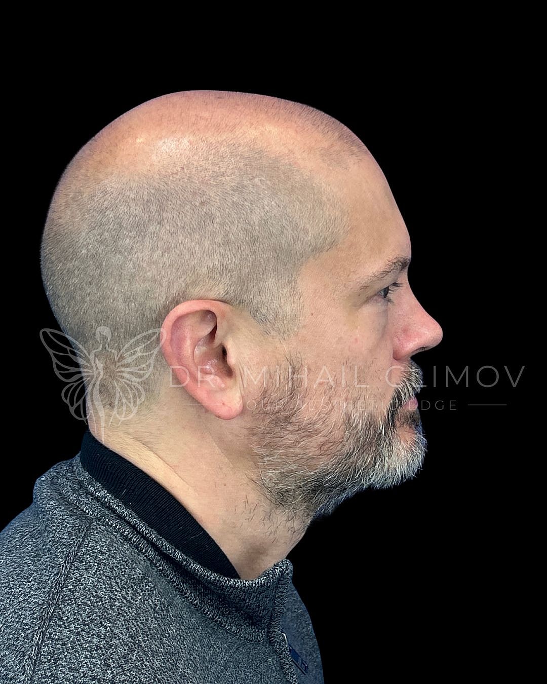 Male upper blepharoplasty before photo, left side view, showing sagging upper eyelid skin and brow heaviness prior to upper eyelid surgery in Houston, Texas.