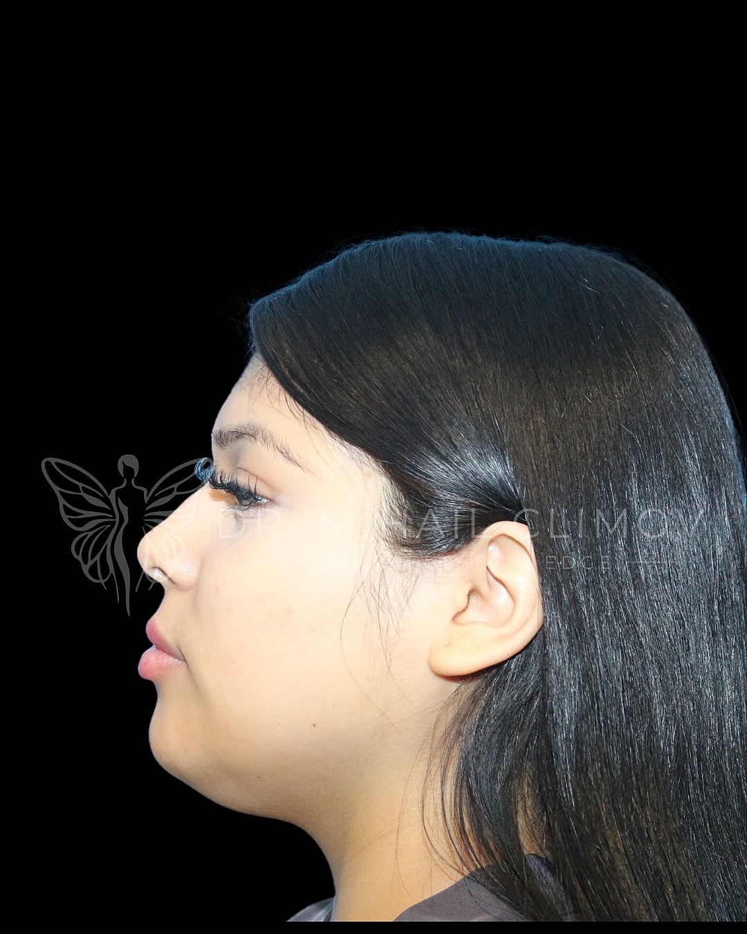 Buccal Fat Removal Before Side, Case A16