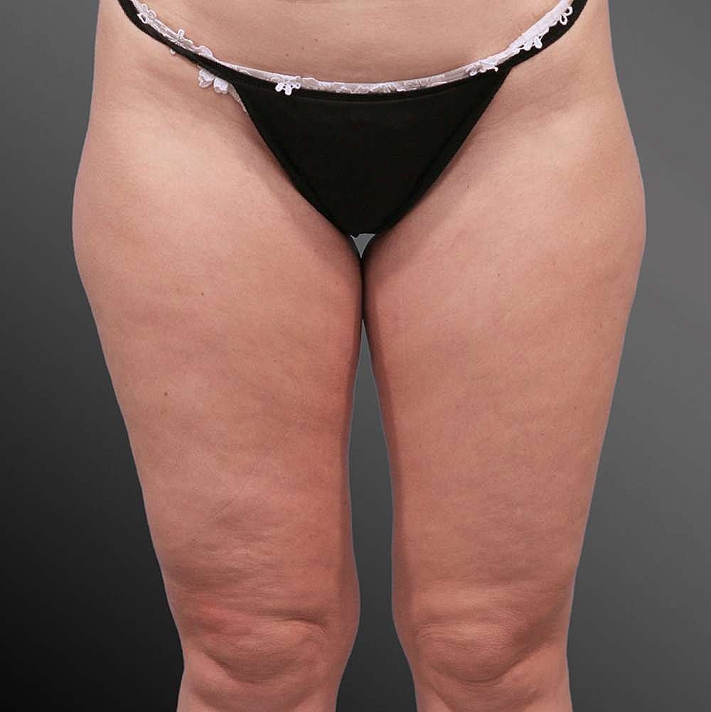 Thigh Contouring Before & After