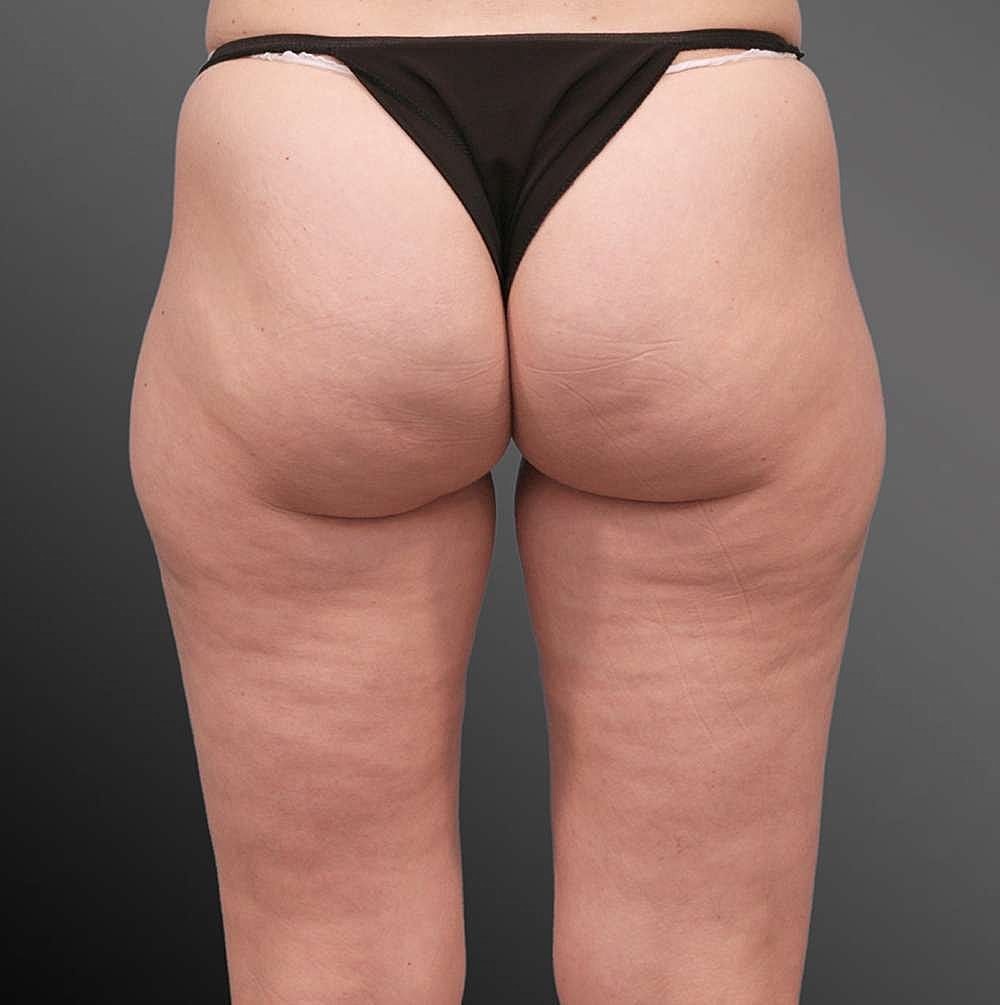 Thigh Contouring Before & After