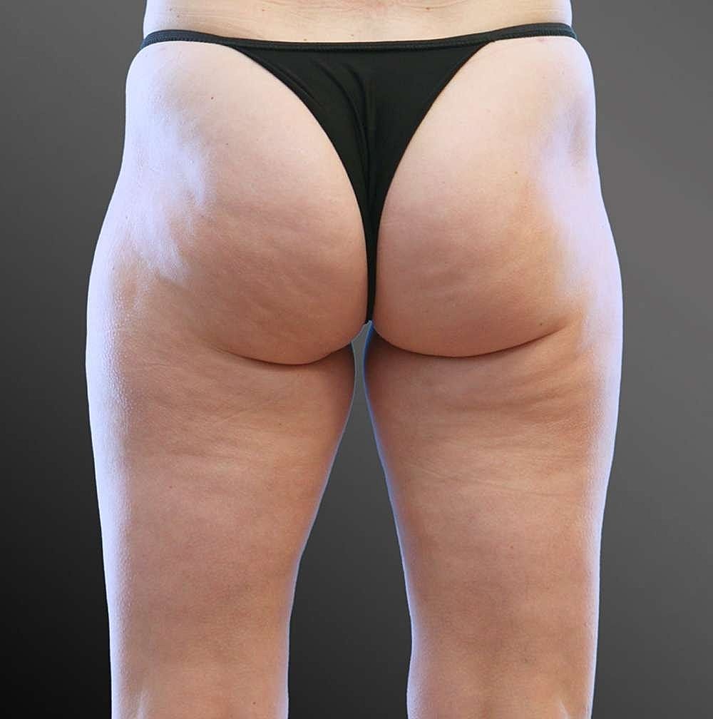 Thigh Contouring Before & After