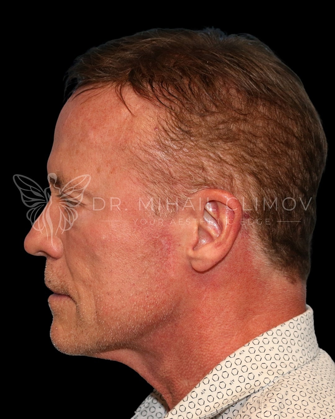 Profile view of a man with short hair.