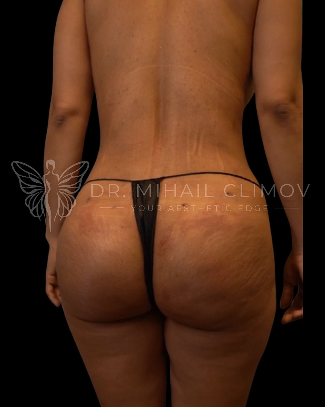 Rear view of body with stretch marks.