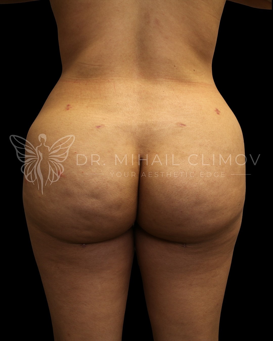 Before and after cosmetic surgery procedure results.
