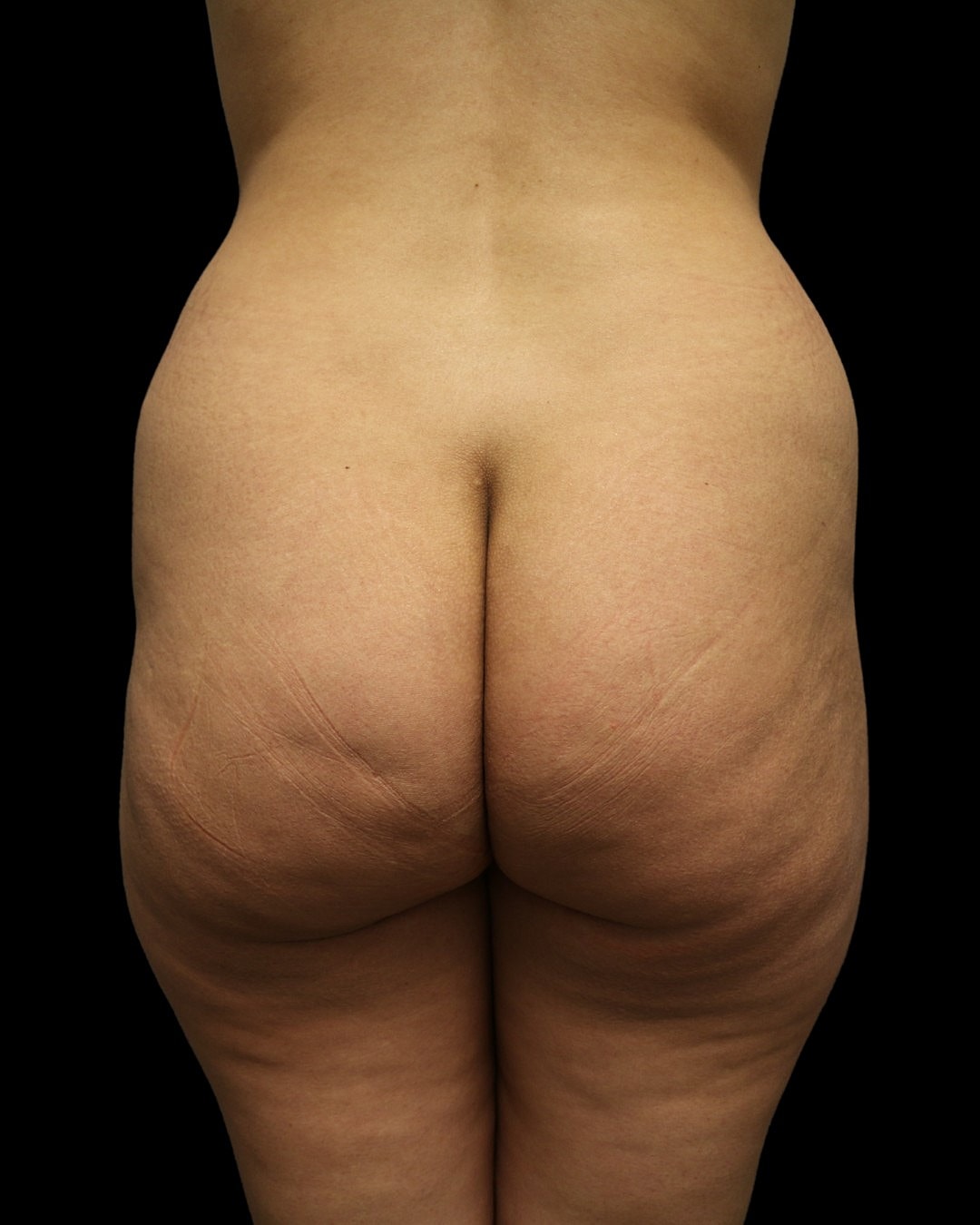 Brazilian Butt Lift Before & After