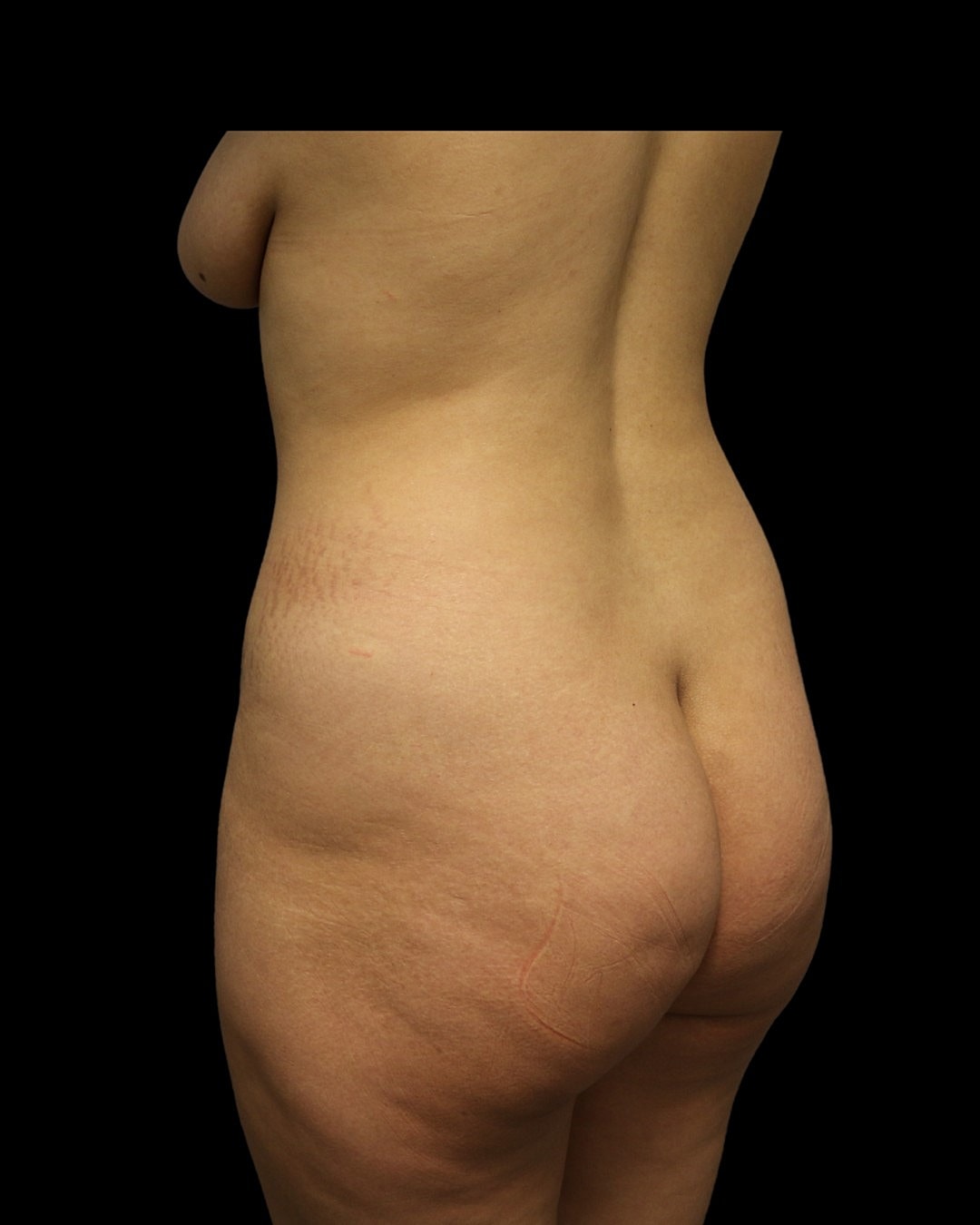 Brazilian Butt Lift Before & After