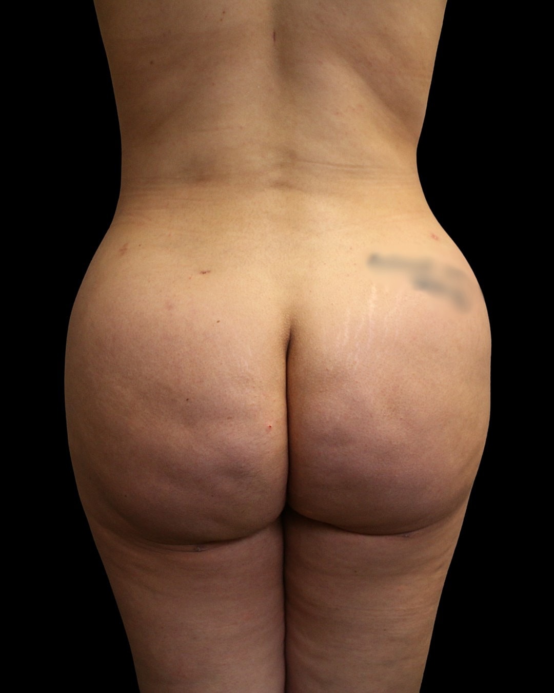 Brazilian Butt Lift Before & After