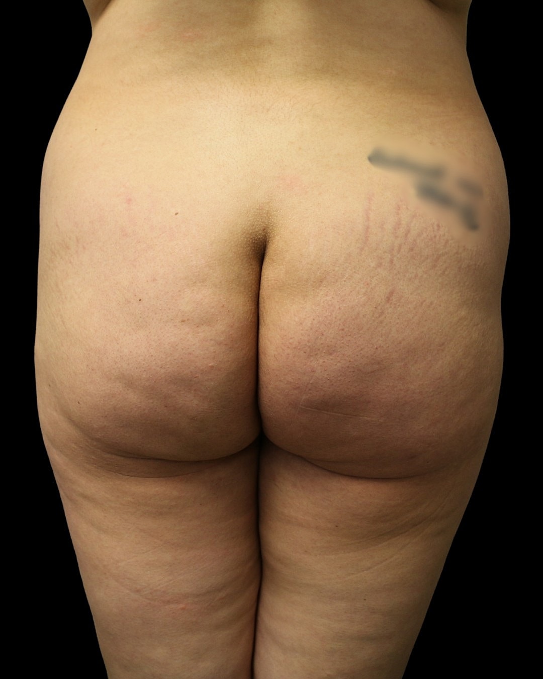 Brazilian Butt Lift Before & After