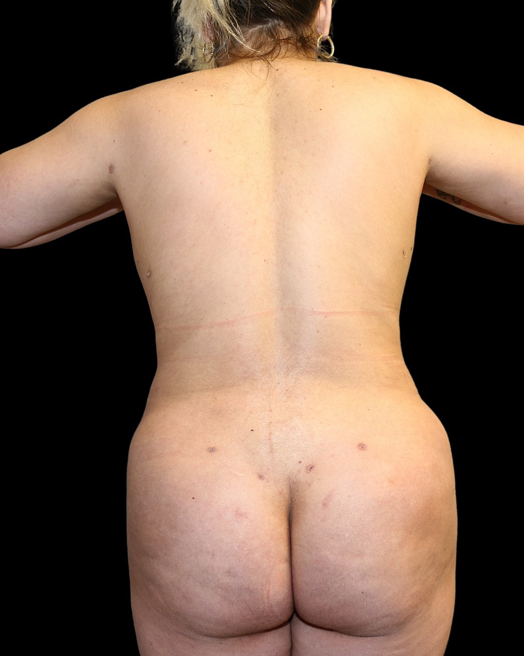 Brazilian Butt Lift Before & After