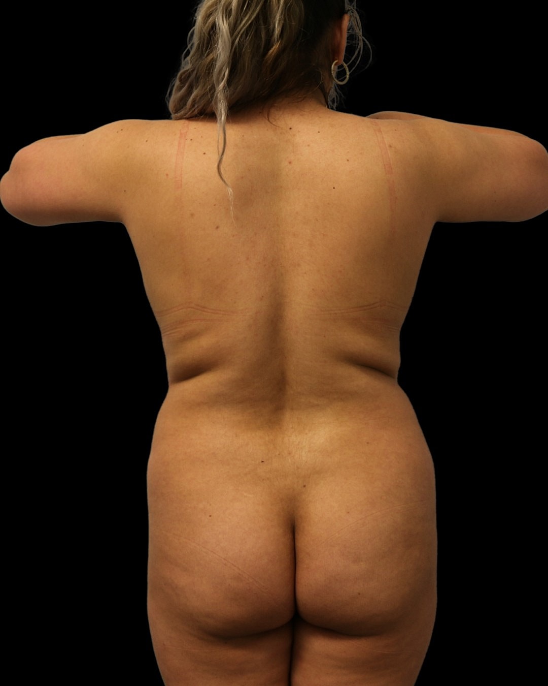 Brazilian Butt Lift Before & After