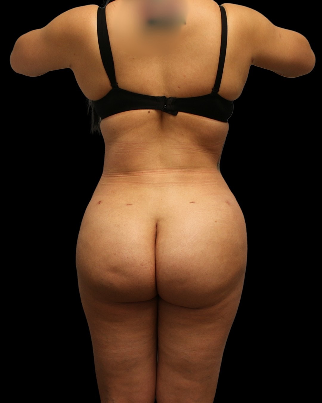 Dr. Mihail Climov BBL before and after Houston