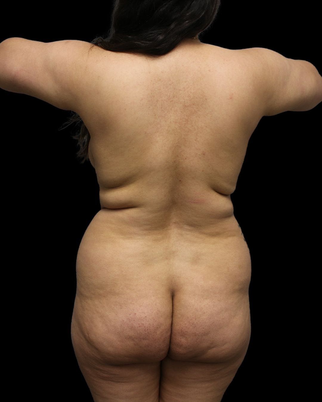 Brazilian Butt Lift Before & After