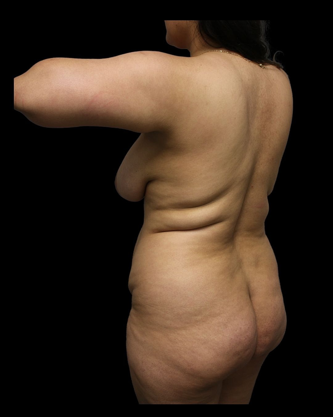 Brazilian Butt Lift Before & After