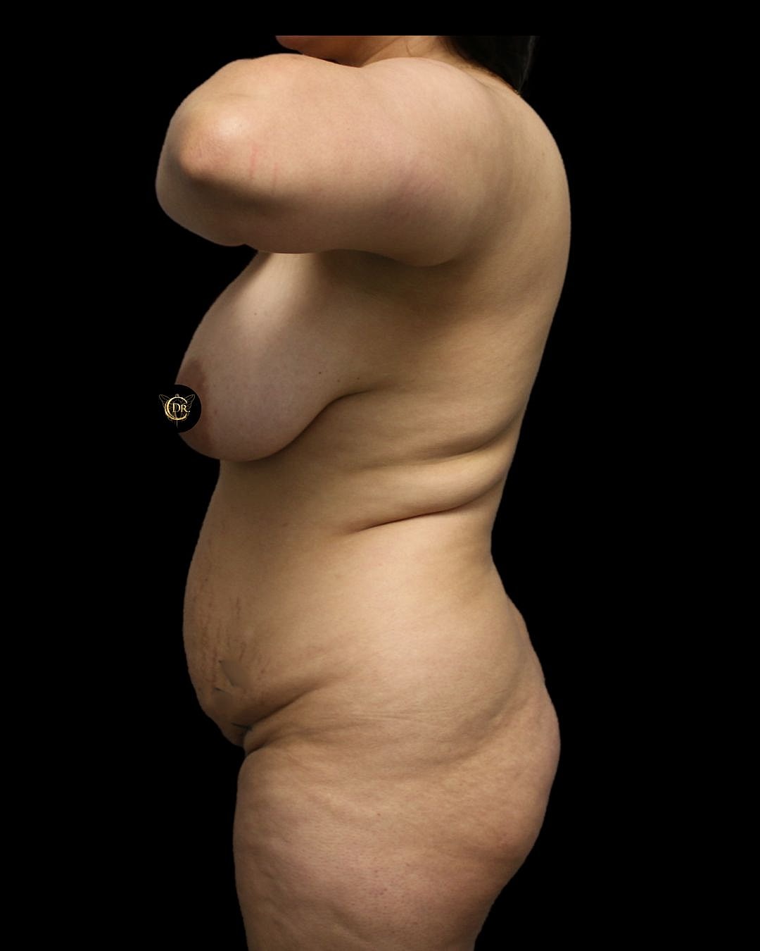 Brazilian Butt Lift Before & After