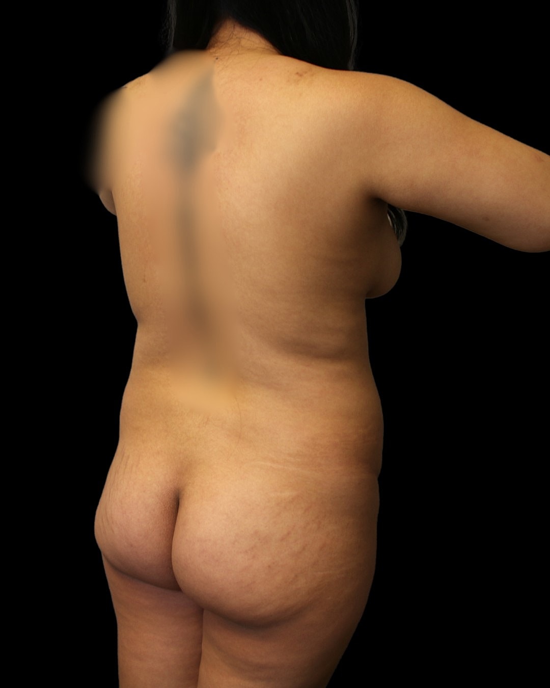 360 liposuction with BBL before and after