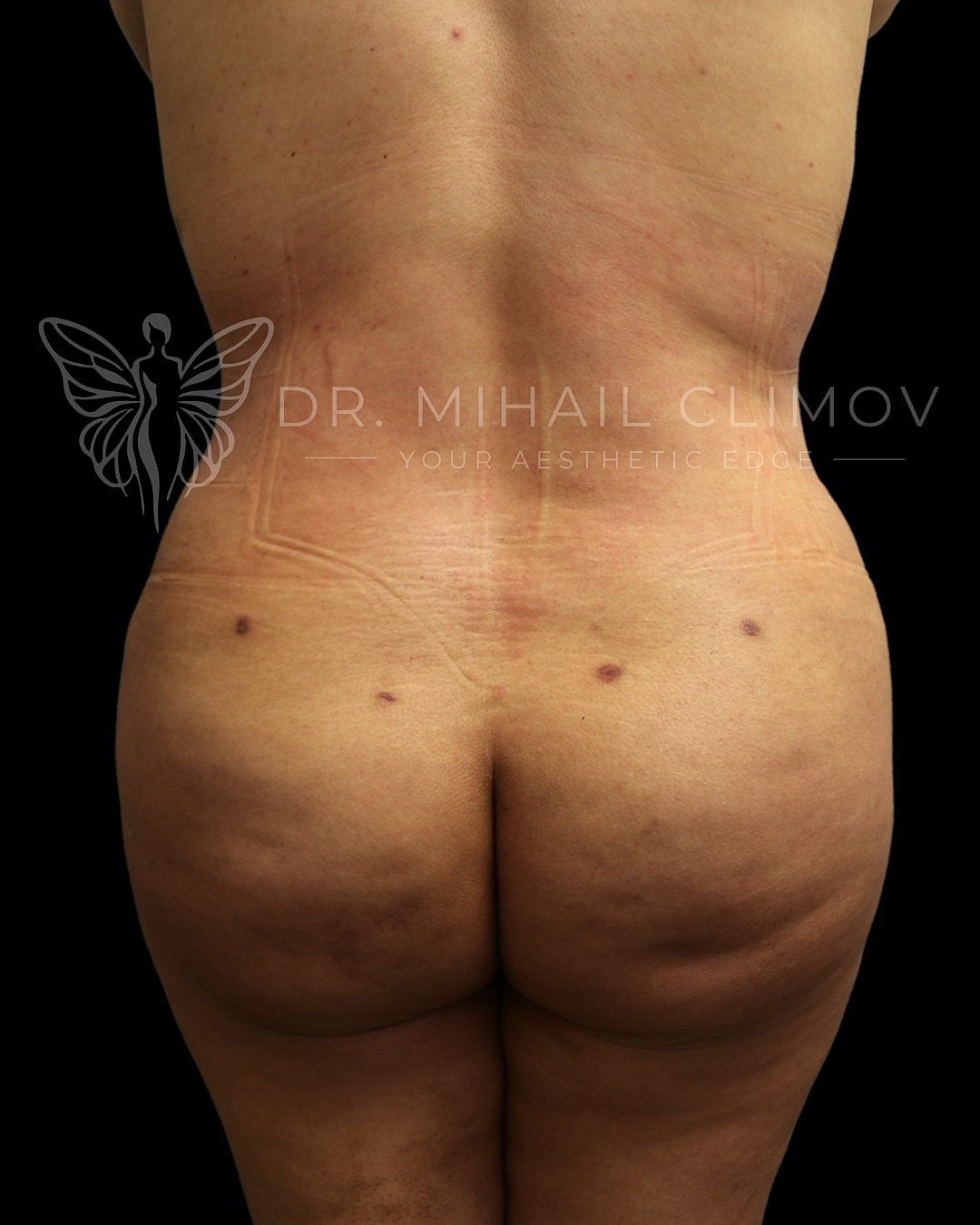Brazilian Butt Lift Before & After