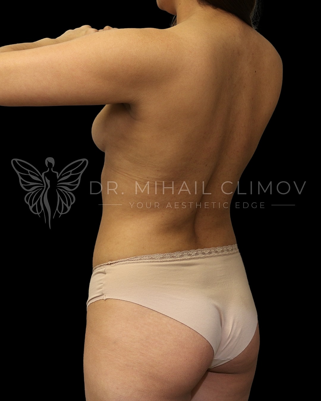 Model showcasing body contouring procedure results.