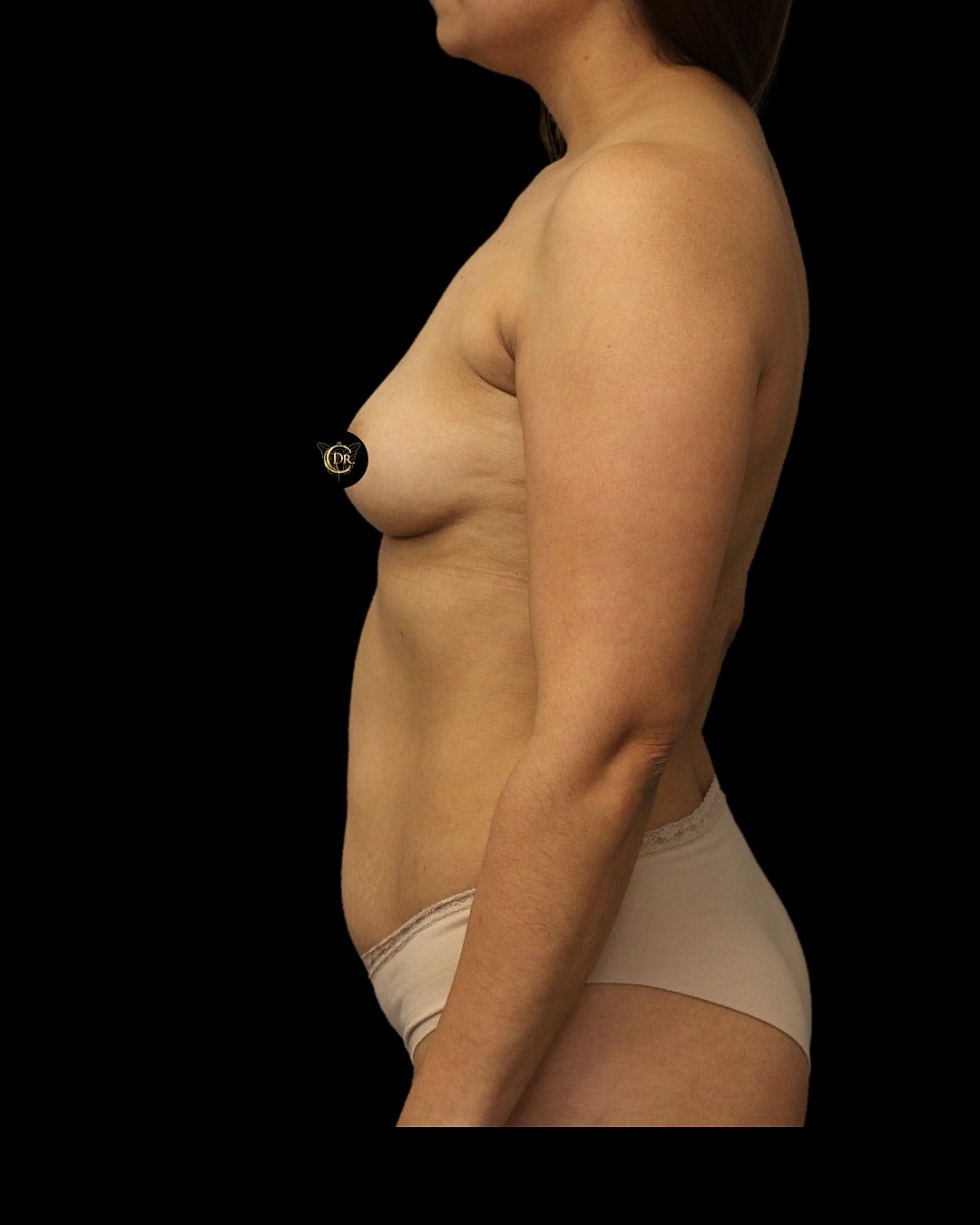 Brazilian Butt Lift Before & After