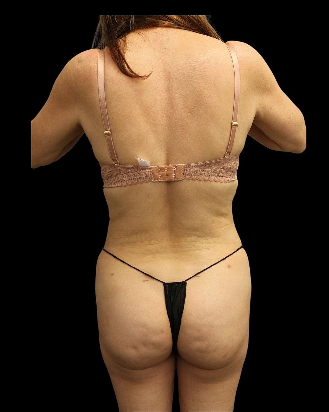 Brazilian Butt Lift Before & After