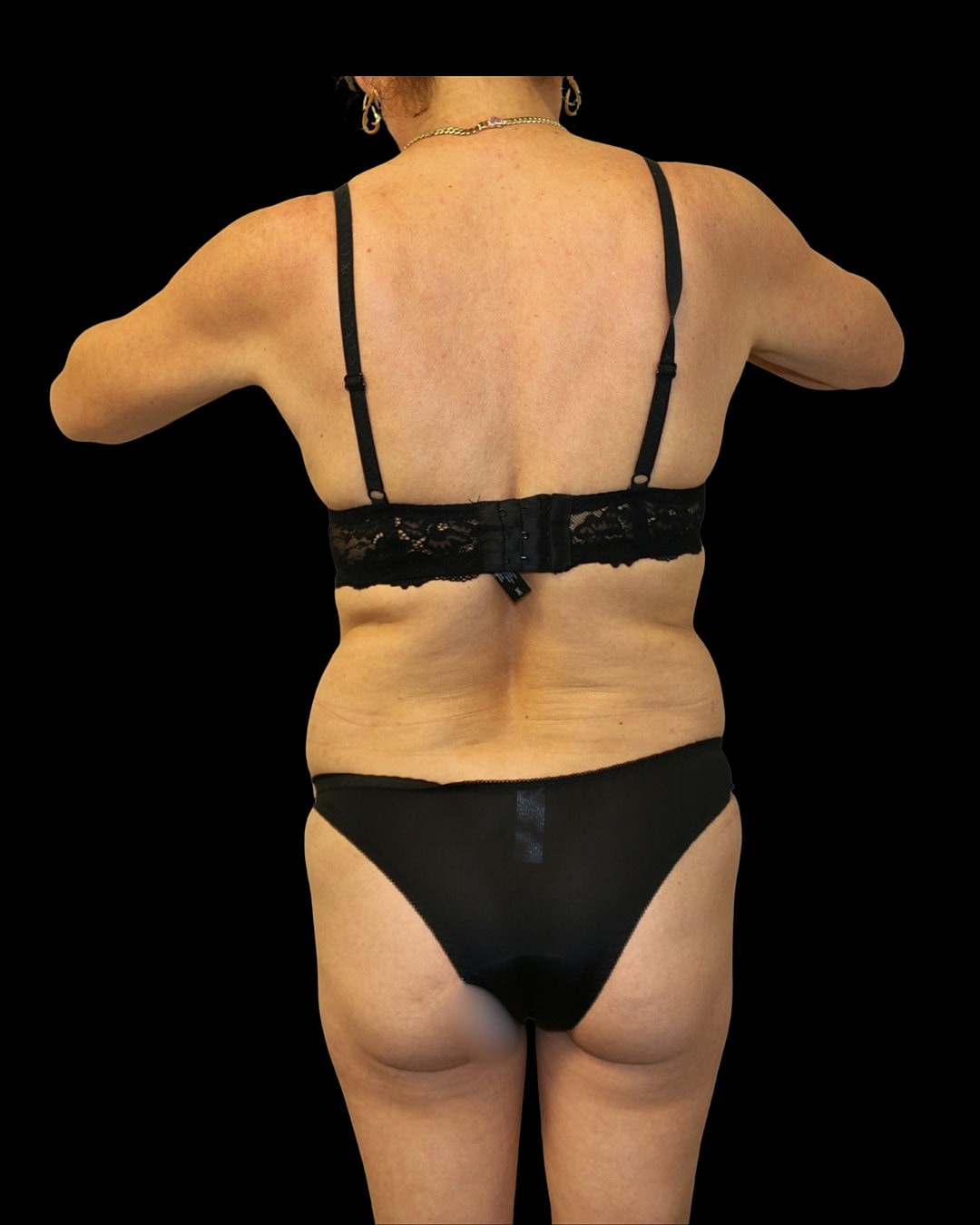 Brazilian Butt Lift Before & After